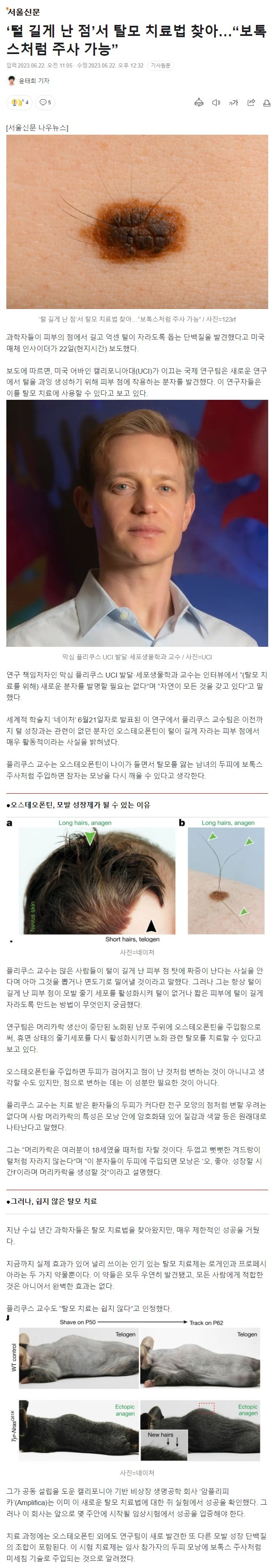 ‘털 길게 난 점’서 탈모 치료법 찾아…“보톡스처럼 주사 가능