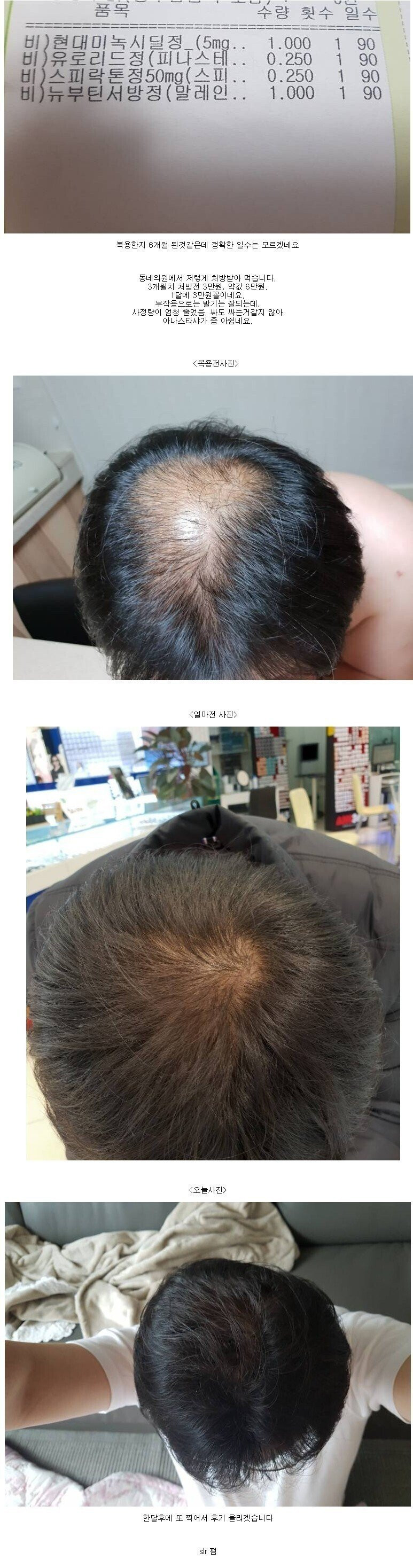 탈모약 후기 레전드 ㄷㄷ